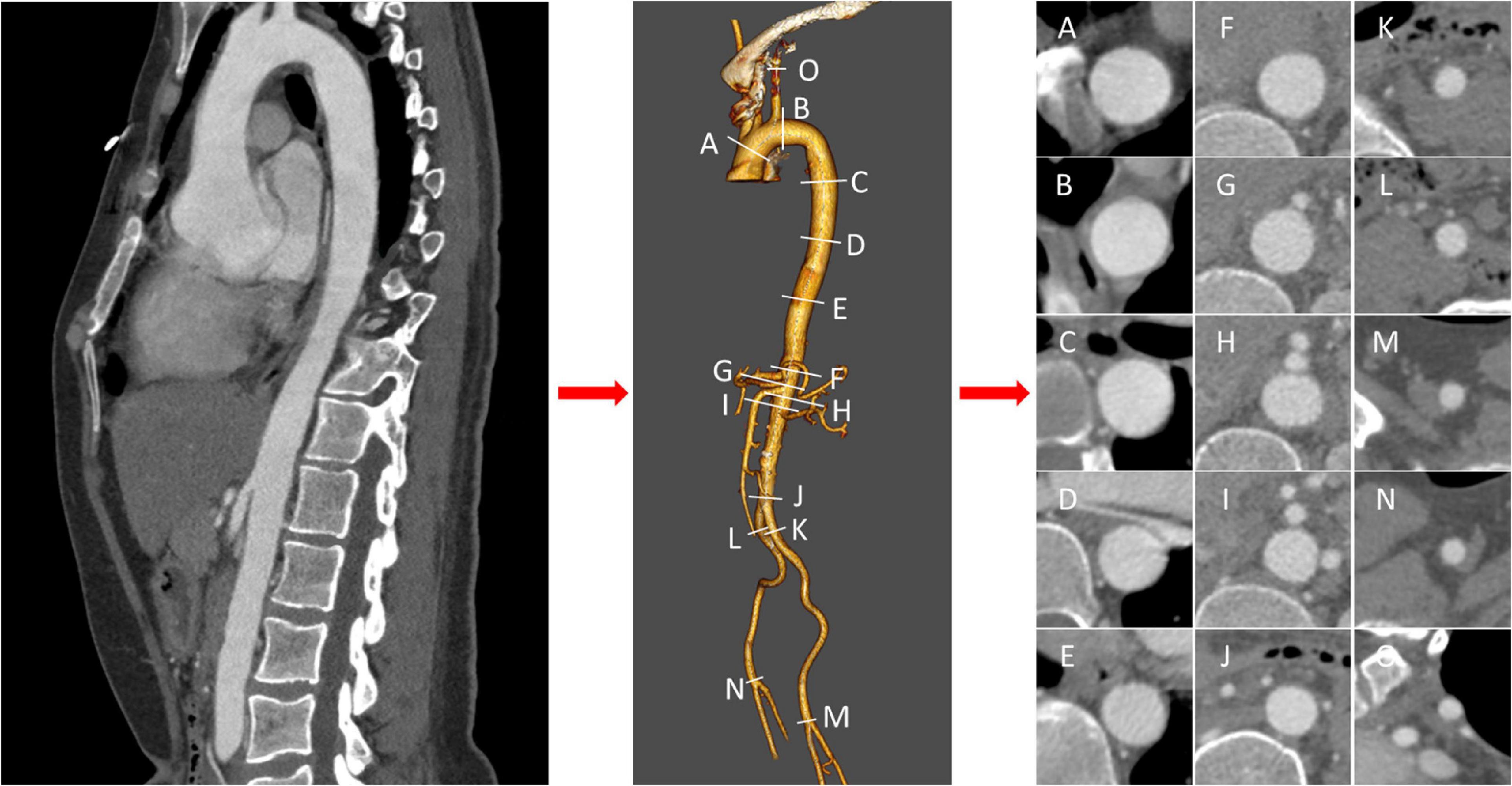 A machine learning approach for predicting descending thoracic aortic diameter